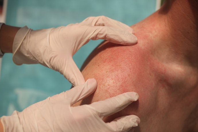 To Prevent Irritation, Consult Your Dermatologist