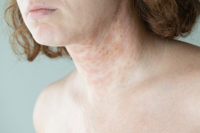 What Is Psoriasis?