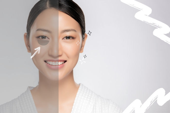 What Causes Dark Circles?