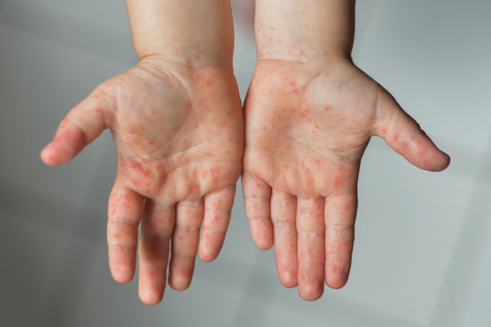 Do Creams Really Help With Hand, Foot, and Mouth Disease?