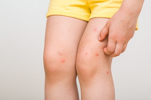 What Makes Insect Bite Creams More Effective Than Regular Lotions?