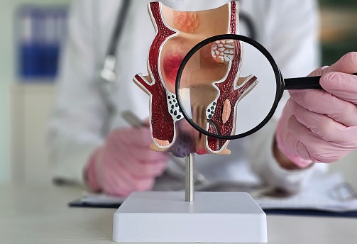 What Causes Hemorrhoids?