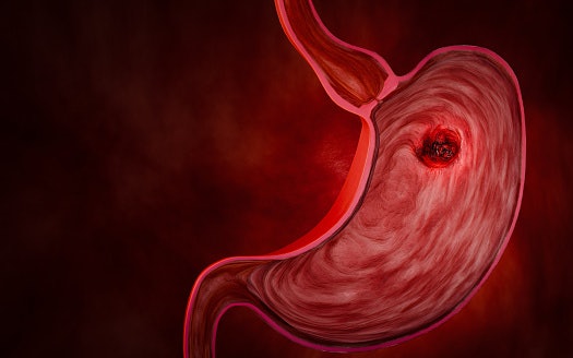 What Are Stomach Ulcers and How Do They Happen?