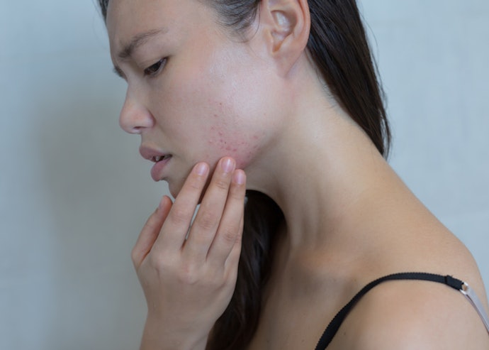 What Causes Acne During Pregnancy?