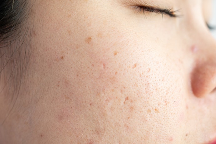 What Causes Large Pores?
