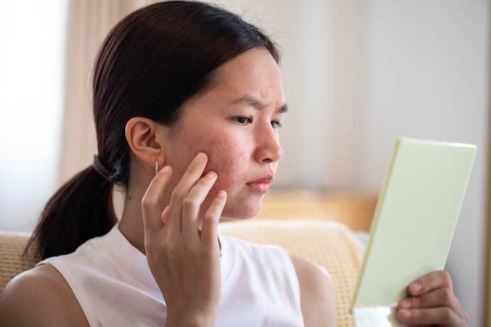 Is Retinol Effective for Treating Acne Breakouts?