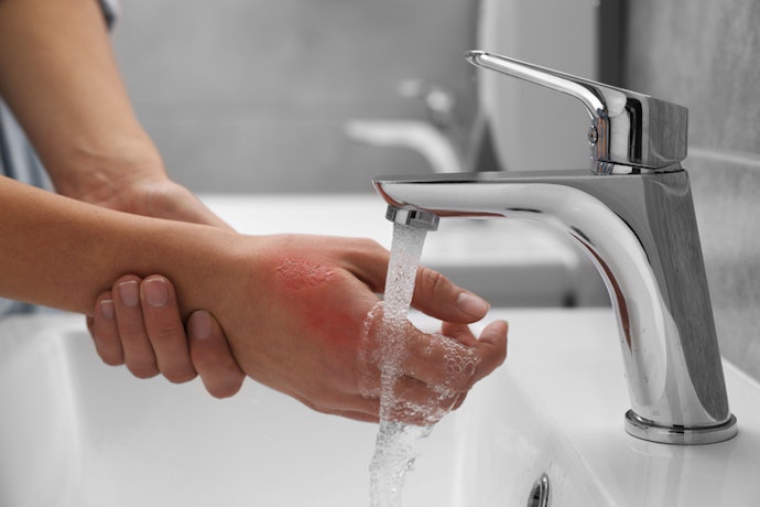 Which Burns Are Safe to Treat at Home?