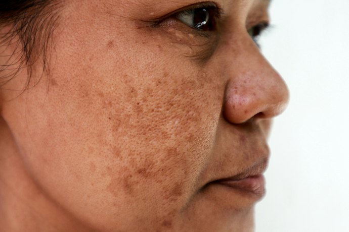 What Is Melasma and What Type Do You Have?
