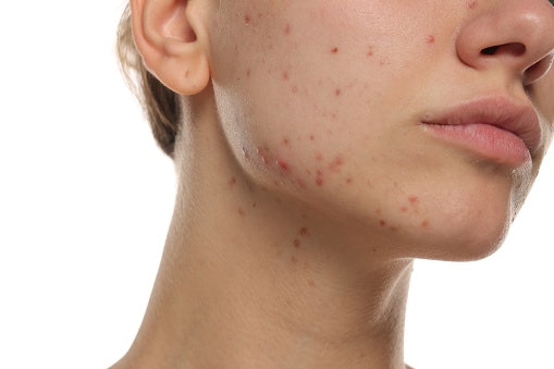 What Is Hormonal Acne and How Is It Different From Other Types of Acne?