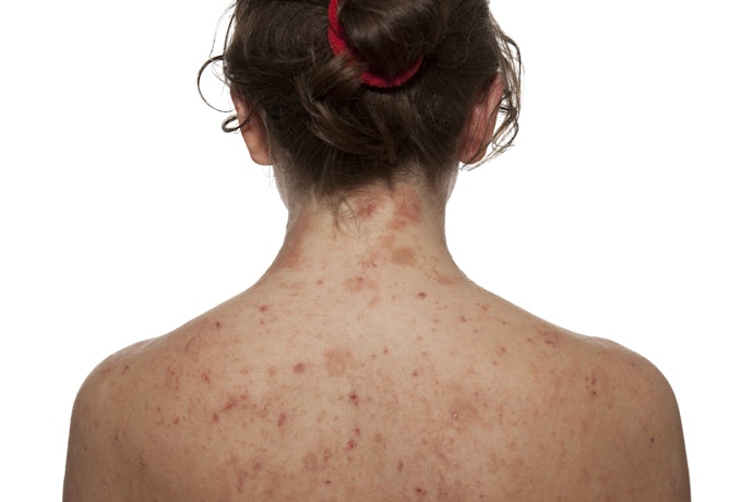 Understanding Eczema and Its Triggers