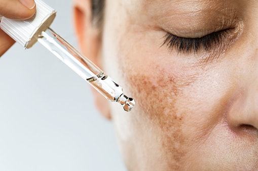 What Causes Dark Spots and How Can Dark Spot Removers Help?
