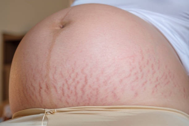 Why Do Stretch Marks Appear During Pregnancy?
