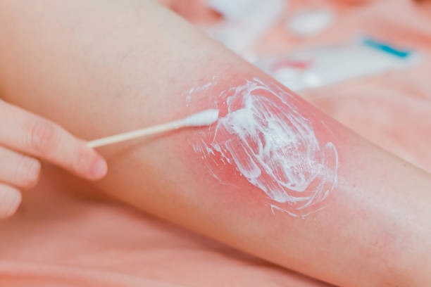 Can an Antibiotic Cream for a Boil Completely Cure the Infection?