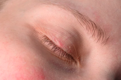 Avoid Eyelid Tapes Made With Latex-Based Adhesives to Prevent Lid Sensitivity