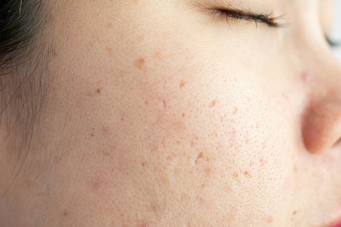 What Causes Large Pores?