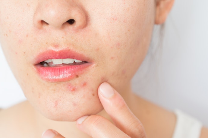 Find an Alcohol-Free Toner with Salicylic Acid for an Acne-Prone Skin