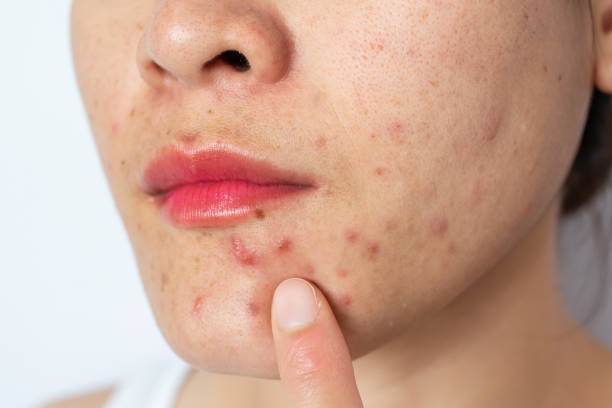 Target Excess Sebum, Enlarged Pores, Blackheads, and Acne, Using An Exfoliating Toner With Salicylic Acid