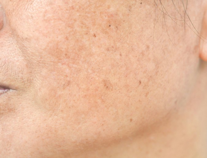 Start With the Right Ingredient for Your Melasma Stage