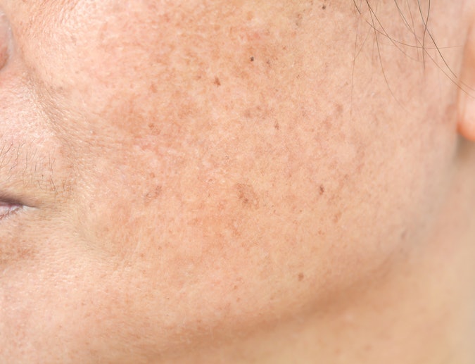 Start With the Right Ingredient for Your Melasma Stage