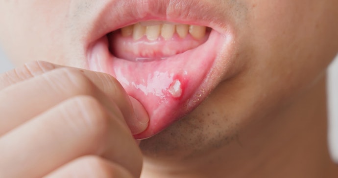 Choose Alcohol-Free or Mild Antiseptic Products if You Have Sensitive Mouth Tissue