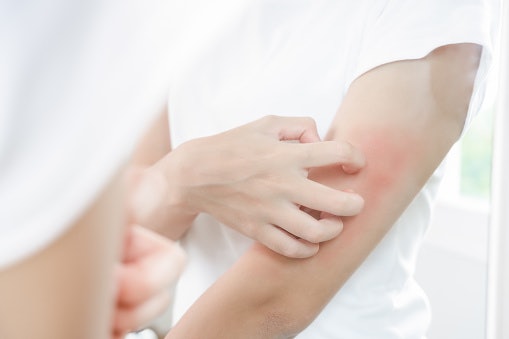 If You Have Sensitive Skin, Consider Gentle, Non-Steroidal Herbal Options