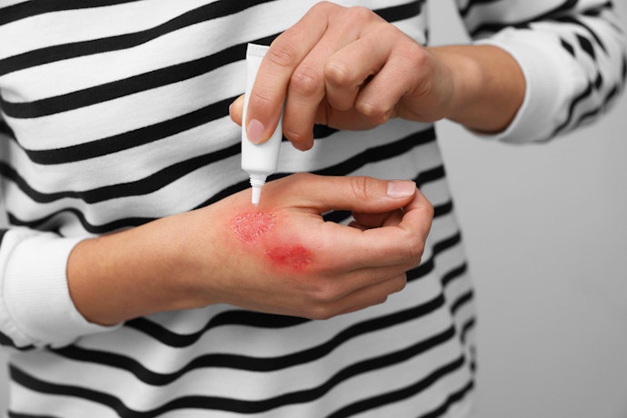 Use Antibacterial or Silver Products Only for Higher-Risk Burns