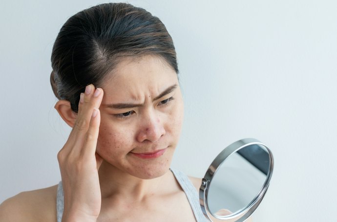 Atrophic Acne Scars Are Sunken or Depressed