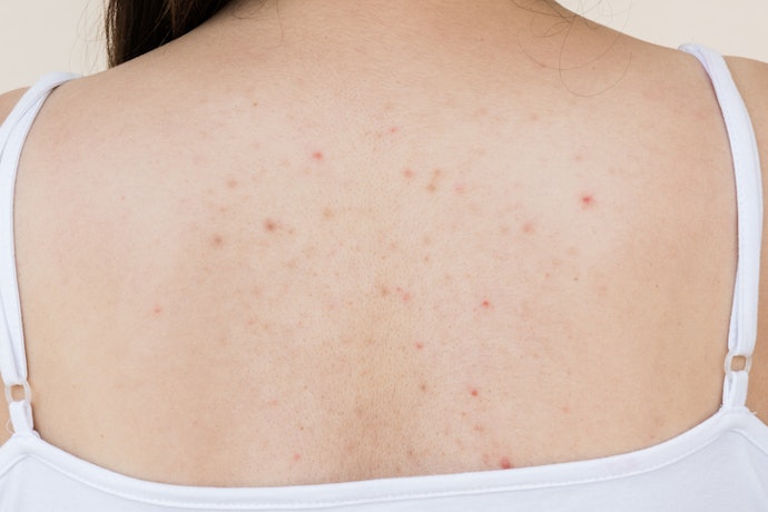 Consider Pregnancy-Safe Options for Body and Hormonal Acne