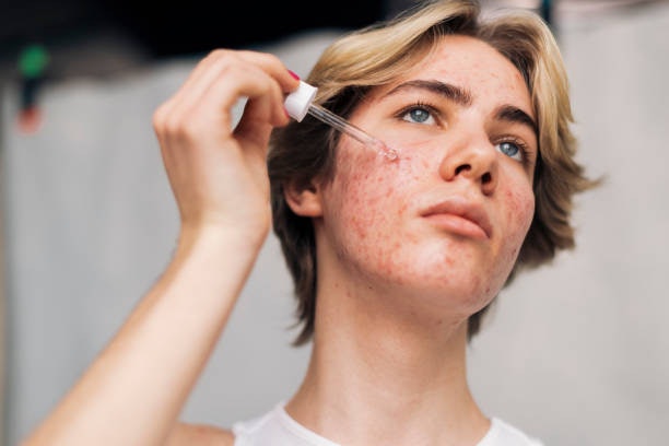 Go for Non-Comedogenic Serums to to Keep Breakouts Under Control