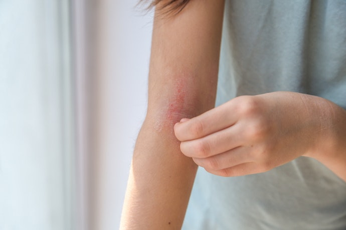 If Steroid-Free Lotions Don’t Work for You, Try Lotions With Hydrocortisone