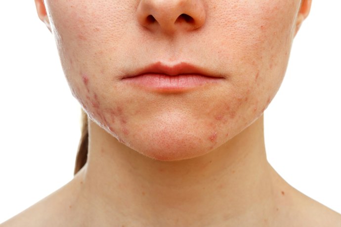 Flat Scars Can Naturally Heal Over Time