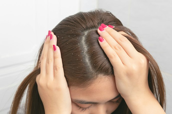 Look for Shampoos or Leave-On Solutions That Contain Ketoconazole, Sulfur, Salicylic Acid, and Zinc Pyrithione