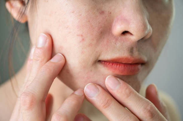 Skip Salicylic Acid Cleansers With Alcohol or Coconut Oil High on the Ingredient List if You’re Prone to Breakouts