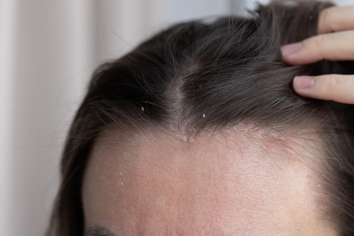Moderate to Chronic Psoriasis: Look for Medicated Shampoos Formulated to Reduce Scaling, Redness, and Itchiness