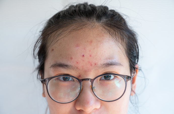 Oily to Acne-Prone Skin: BHAs Can Help Regulate Sebum Production