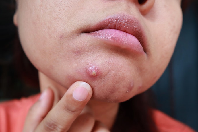 Microneedle Patches for Cystic Acne