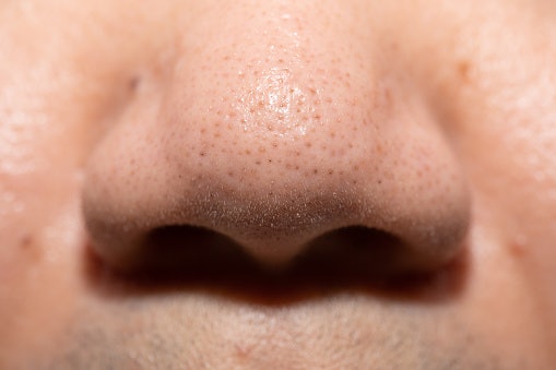 Salicylic Acid (BHA) Exfoliates and Clears Clogged Pores