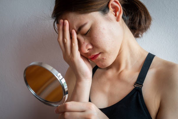 For Oily Skin, Opt For Ingredients That Lessen Excess Sebum