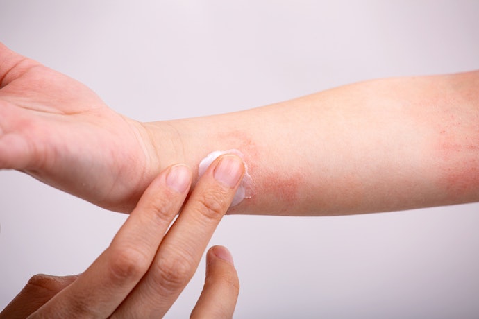 For Long-Term Use and Sensitive Skin: Opt for Steroid-Free Alternatives Like Pimecrolimus