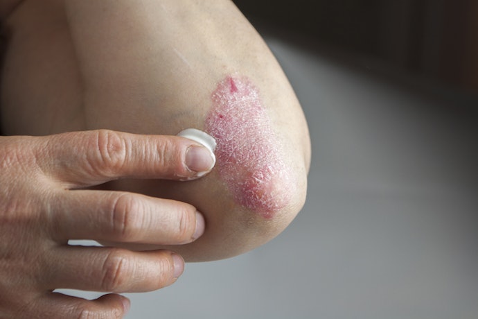 To Soften and Reduce Thick Plaques: Active Treatments Such as Salicylic Acid and Coal Tar