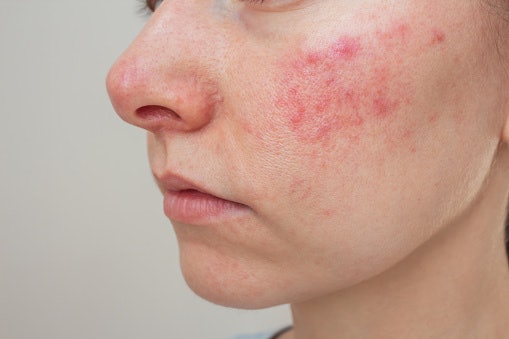 Niacinamide or Centella Asiatica Calms Inflammation and Speeds Up Healing