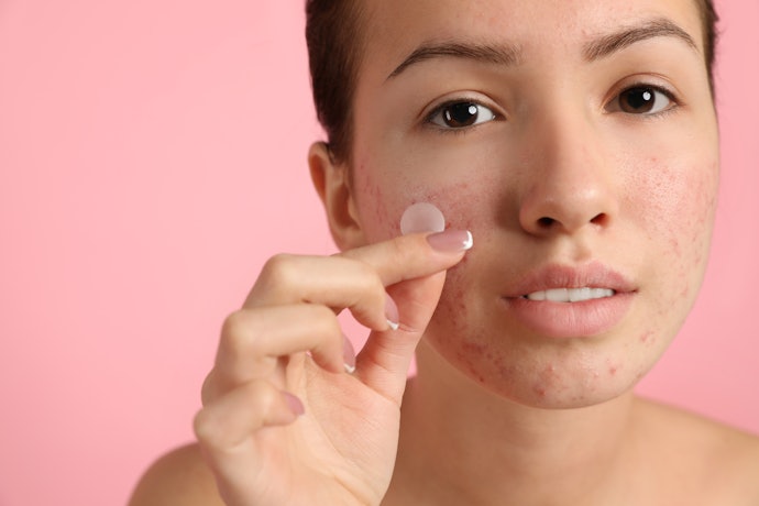 Acne Patches Work Best for Inflamed Acne and Protect Against Irritants