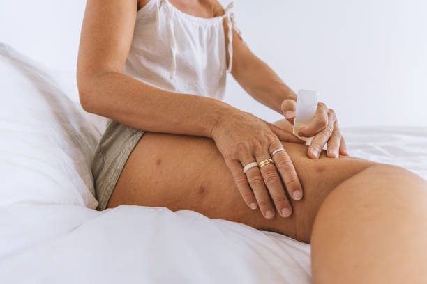 Calamine or Zinc Oxide: Soothes Itching and Dries Out Bites