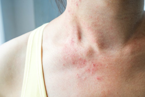 For Sensitive or Irritated Skin: Choose Fragrance-Free Options With Calming Ingredients