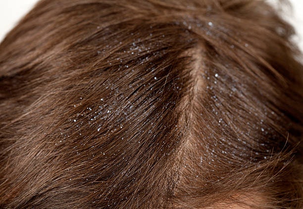 For Oily or Dandruff-Prone Scalp: Tea Tree, Peppermint, or Salicylic Acid Balance Oil and Calm Irritation