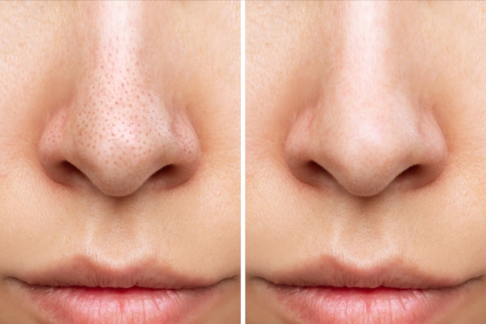 To Clear Clogged Pores: Look for BHA, LHA, and Mandelic Acid
