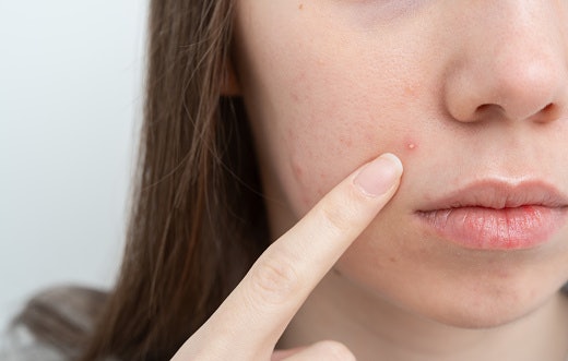 Use Non-Comedogenic Bases to Prevent Further Pore Clogging