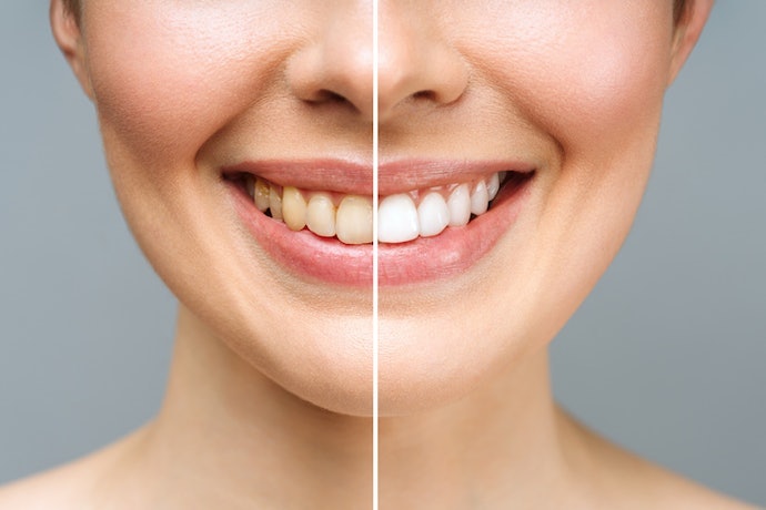 For Deep, Intrinsic Whitening: Check for Hydrogen or Carbamide Peroxide