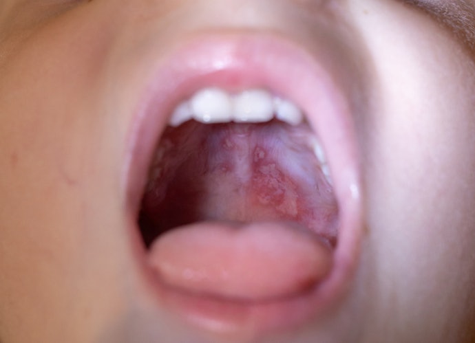 Choose Age-Appropriate Oral Anesthetic Gels and Follow Directions Exactly