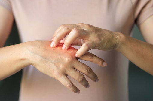 Topical Anesthetics Such As Pramoxine and Benzocaine for Numbing the Affected Skin